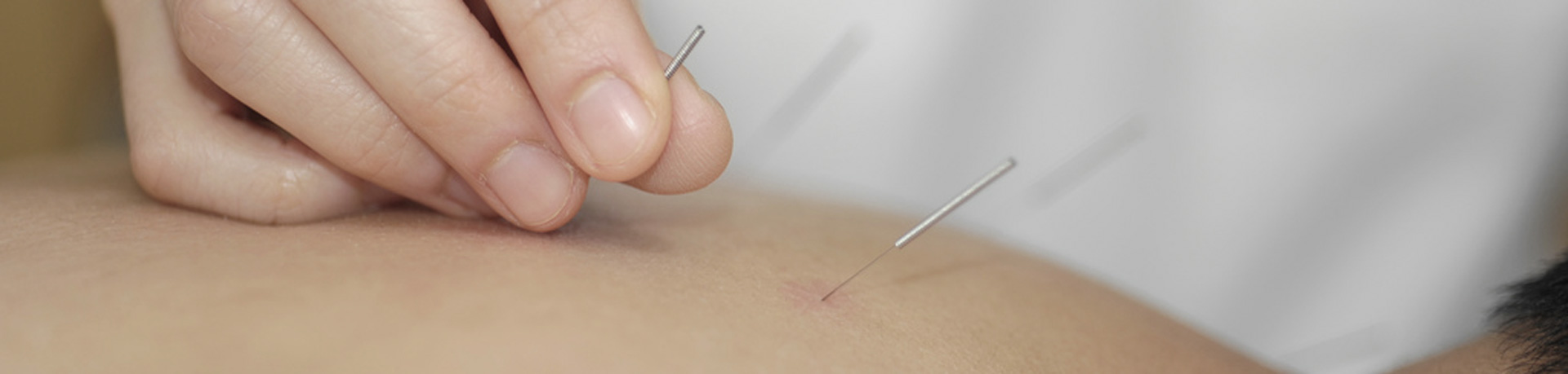 Dry-Needling