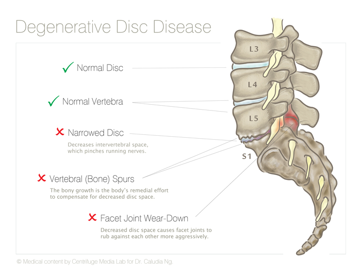 Degenerative Disc Disease