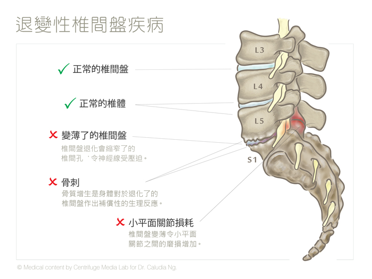 因慢性腰部扭傷／勞損引致的退變性椎間盤疾病