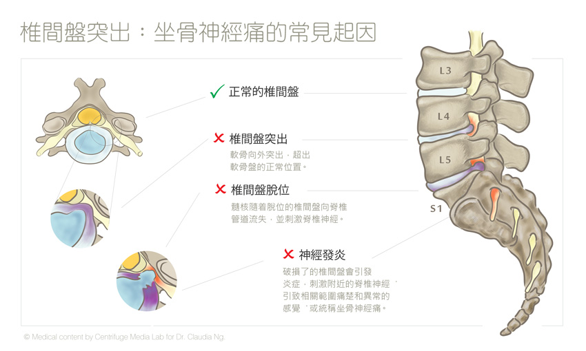 椎間盤突出