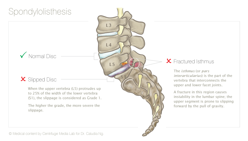 Spondylolisthesis