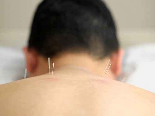 Dry-Needling